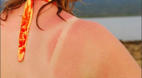 Cách chữa da bị cháy nắng nhanh và hiệu quả - ảnh 1