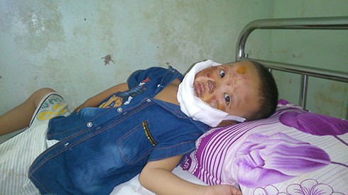 Cảnh giác và phòng ngừa tai nạn bỏng ở trẻ em - ảnh 1