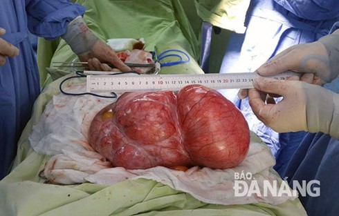 Phẫu thuật thành công u lớn hiếm gặp nặng 4,3 kg - ảnh 1