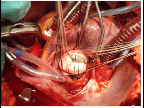 Cứu sống cụ bà 90 tuổi có khối u ở tim - ảnh 1