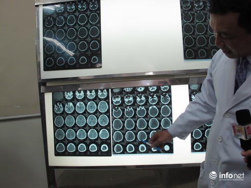 Bị chồng đánh chấn thương sọ não, liệt nửa người - ảnh 2