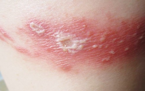 TPHCM: Sinh viên hãi hùng vì bị kiến ba khoang “tấn công” - ảnh 1