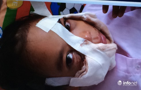 Sơ cứu đúng cách khi trẻ bị chó cắn - ảnh 1