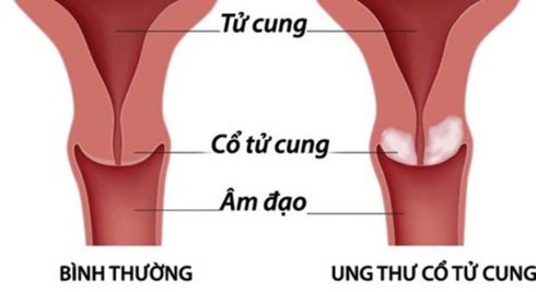 Dấu hiệu ung thư cổ tử cung bạn cần biết - ảnh 1