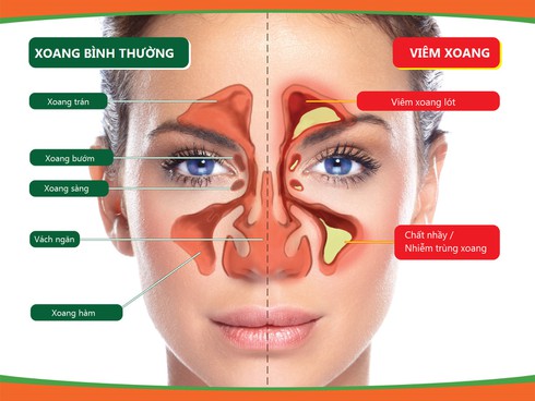 Viêm mũi xoang dị ứng có thể điều trị khỏi - ảnh 1