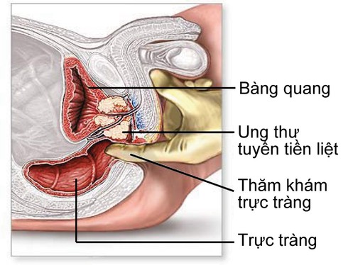 80 bác sĩ chuyên khoa đầu ngành bàn về điều trị ung thư tuyến tiền liệt - ảnh 1