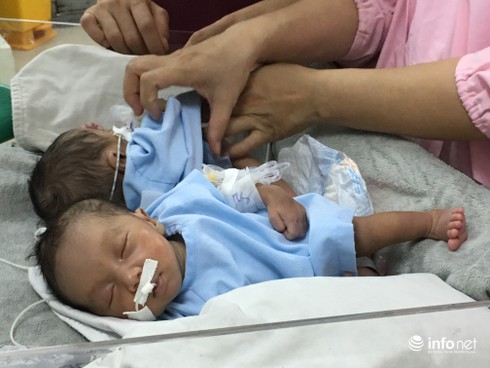 Lên phương án tách rời hai bé sơ sinh dính liền phần mông - ảnh 1