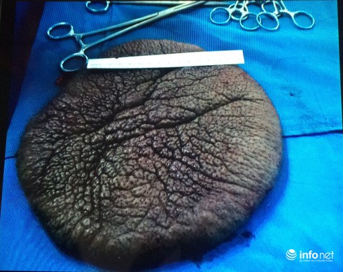 Gỡ bỏ thành công “mai rùa” trên lưng bé gái 10 tuổi - ảnh 2