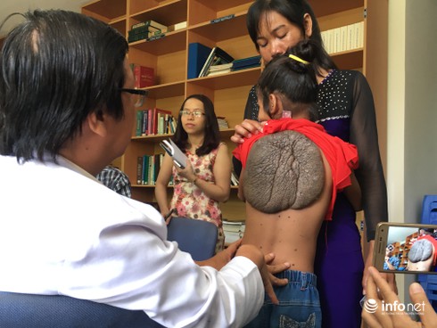 Gỡ bỏ thành công “mai rùa” trên lưng bé gái 10 tuổi - ảnh 3