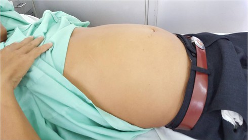 Lấy 2 khối bướu khổng lồ trong bụng bệnh nhân - ảnh 1