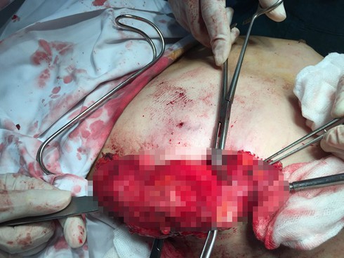 Cắt hết tuyến vú vì bơm silicon dạo - ảnh 1