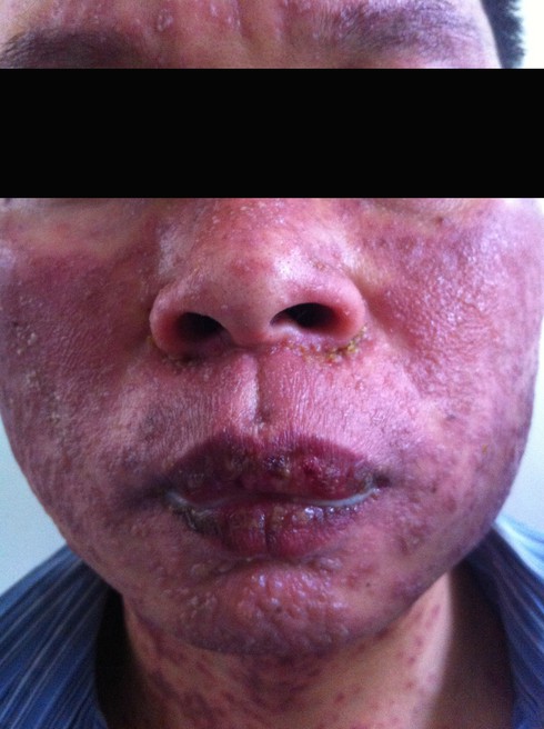 Kinh khủng gương mặt bị hoại tử do dị ứng kháng sinh, mỹ phẩm - ảnh 1