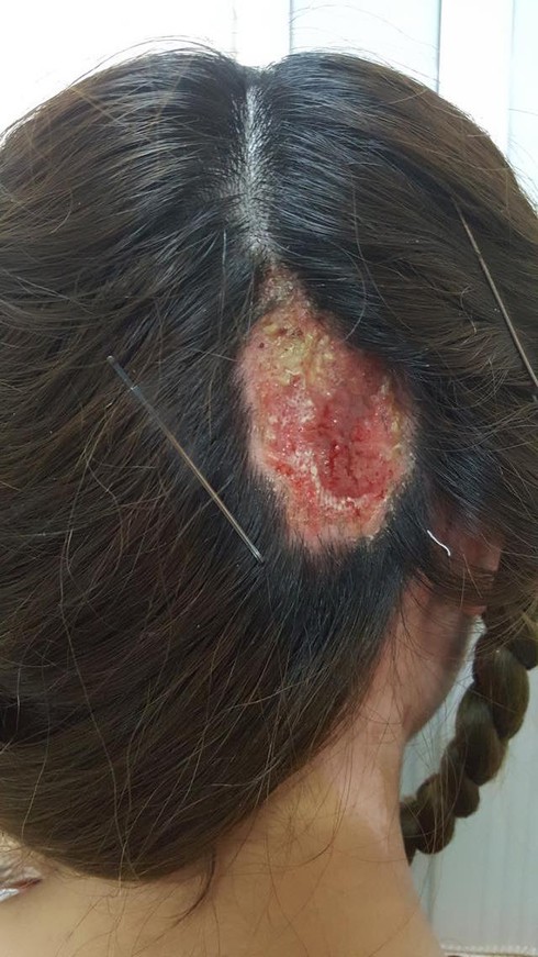 Hai phụ nữ nhập viện vì bong da đầu, hoại tử vành tai sau khi làm tóc - ảnh 1