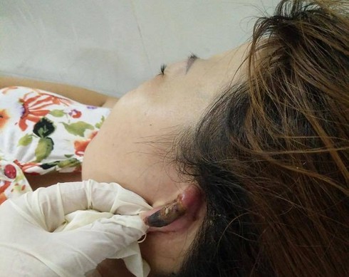 Hai phụ nữ nhập viện vì bong da đầu, hoại tử vành tai sau khi làm tóc - ảnh 2