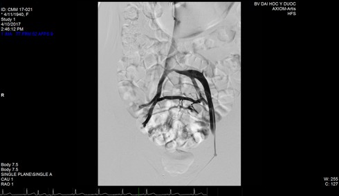 Lần đầu tiên đặt stent tĩnh mạch bằng một mũi kim châm - ảnh 2
