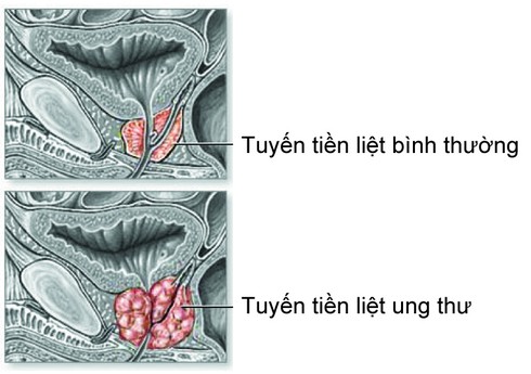 Cắt hết tinh hoàn vì ung thư tiền liệt tuyến - ảnh 1