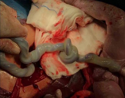 Bé trai chào đời với dây rốn thắt nút - ảnh 1