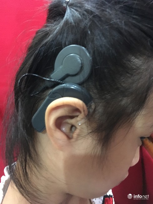 Cơ hội vàng cho trẻ điếc bẩm sinh có thể nghe nói - ảnh 1