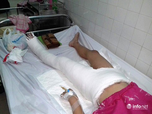 Đà Nẵng: Bác sĩ nói về trường hợp cháu bé bị lệch xương đùi sau khi bó bột - ảnh 1