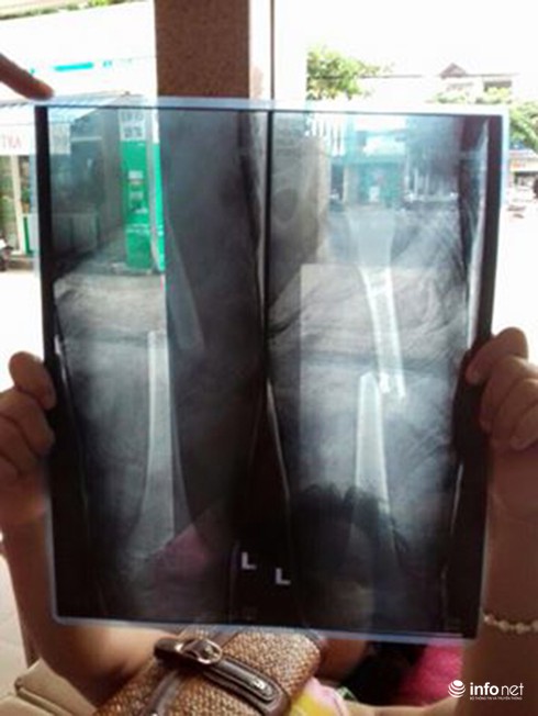 Đà Nẵng: Bác sĩ nói về trường hợp cháu bé bị lệch xương đùi sau khi bó bột - ảnh 2