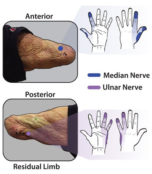 Da điện tử giúp người cụt chi cảm nhận được cảm giác đau và đồ vật - ảnh 2