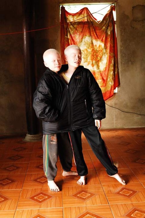 Bộ ảnh độc về cặp song sinh bạch tạng ở Hà Tĩnh - ảnh 3