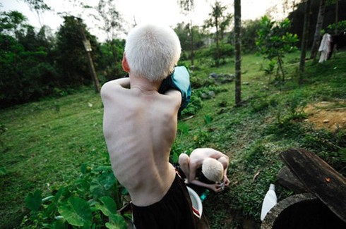 Bộ ảnh độc về cặp song sinh bạch tạng ở Hà Tĩnh - ảnh 8