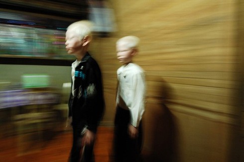 Bộ ảnh độc về cặp song sinh bạch tạng ở Hà Tĩnh - ảnh 10