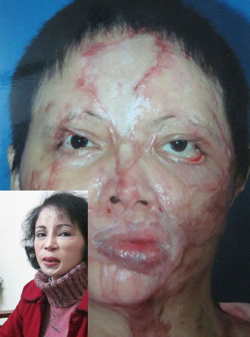 Gặp người 41 lần phẫu thuật làm đẹp - ảnh 1