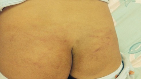 Bé 3 tuổi học trường phí 9 triệu vẫn bị đánh lằn mông - ảnh 1