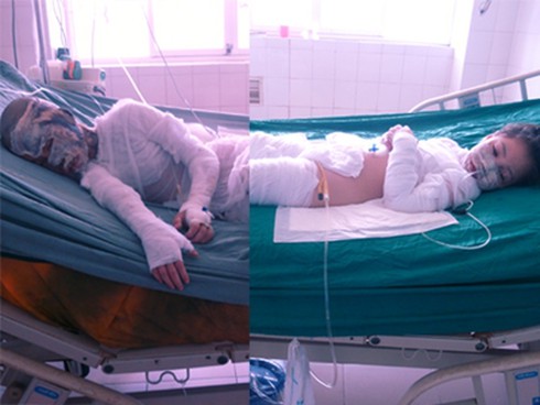 Nạn nhân bỏng axit sống như chết: Cần tăng hình phạt lên chung thân - ảnh 2
