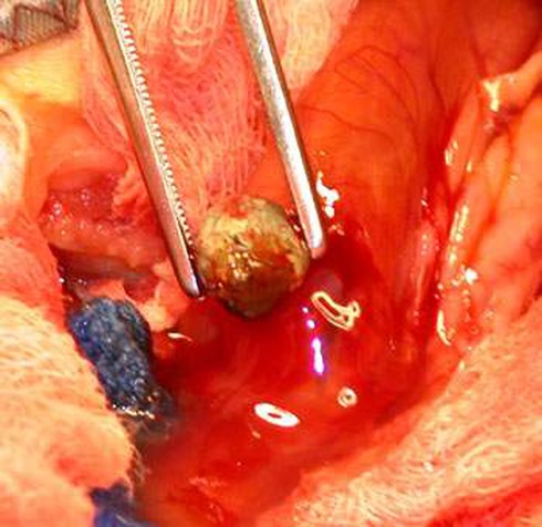 Những dấu hiệu cảnh báo sỏi bàng quang - ảnh 1