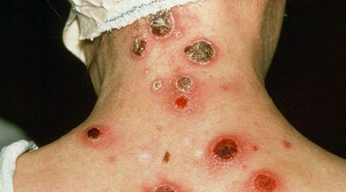 Điểm danh bệnh lây qua đường tình dục dễ gặp - ảnh 3