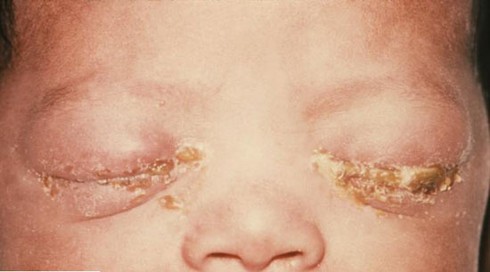 Điểm danh bệnh lây qua đường tình dục dễ gặp - ảnh 2