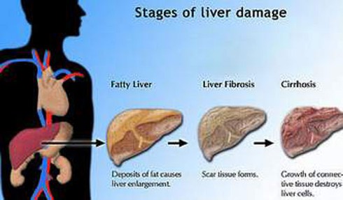 Viêm gan C mạn tính và nguyên tắc điều trị - ảnh 1