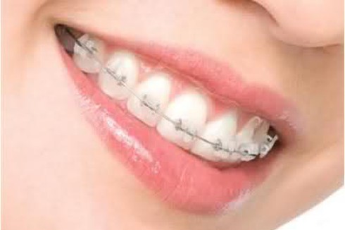 Lời khuyên của nha sĩ khi nắn chỉnh răng - ảnh 1