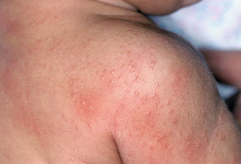 Rôm sảy ở trẻ: Nguyên nhân, phương pháp điều trị - ảnh 1