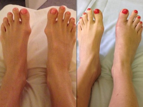 Cận cảnh cắt ngón chân để đi vừa giày cao gót - ảnh 6