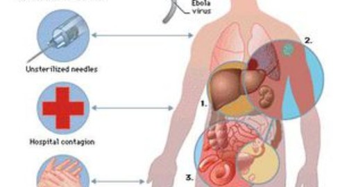 Bộ Y tế chính thức công bố phác đồ điều trị bệnh do vi rút Ebola - ảnh 1