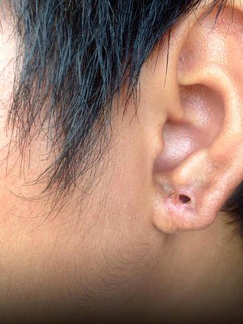 Bấm lỗ tai để lại sẹo lồi khủng - ảnh 2