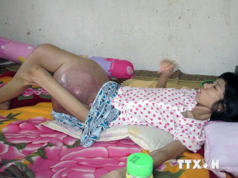 Người phụ nữ có khối u nặng gần 10kg ở đùi - ảnh 3