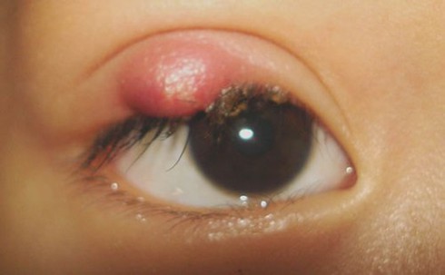 Cách chữa lẹo mắt nhanh nhất - ảnh 1