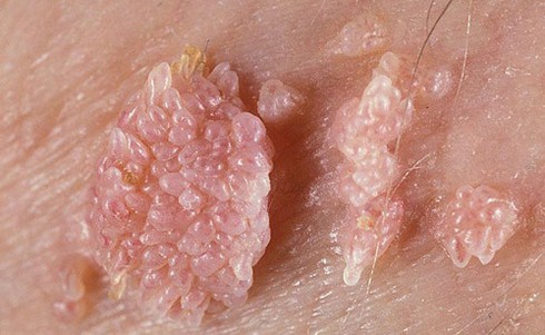 Cách trị bệnh sùi mào gà đúng - ảnh 1