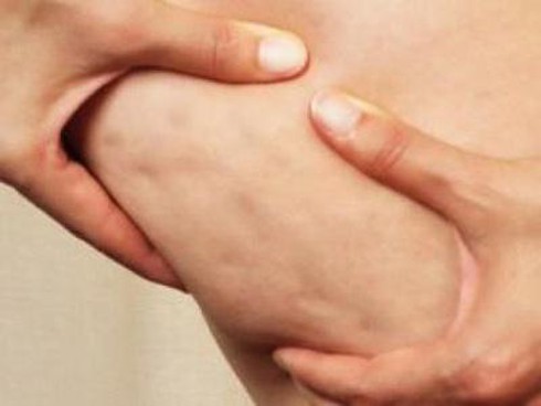 Giải mã bí ẩn da sần vỏ cam - ảnh 1