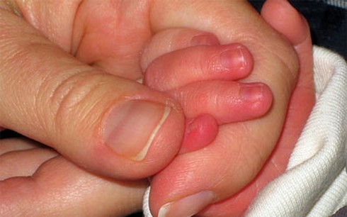 Xử lý khi bị cước tay chân trong ngày lạnh - ảnh 1