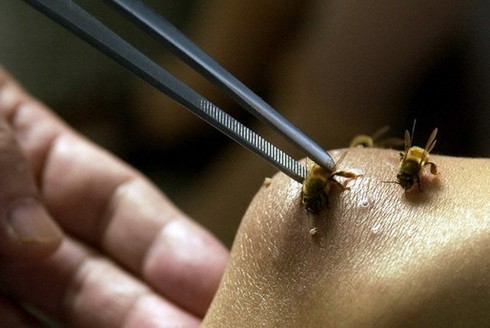 Cứu trẻ bị ong vò vẽ đốt gần 170 mũi - ảnh 1