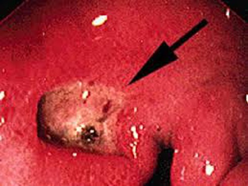 Loét dạ dày, nửa đêm dậy khóc tu tu - ảnh 1