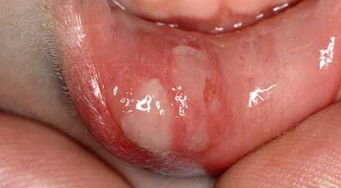 Nhận diện bệnh thường gặp ở miệng - ảnh 1