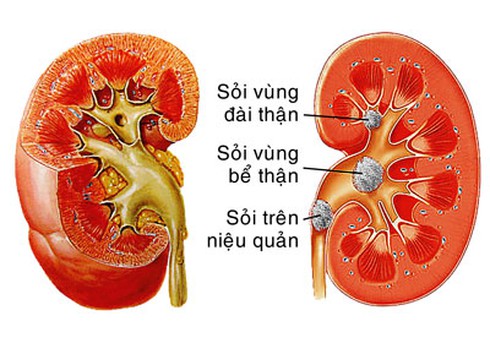 Nguy biến do thừa canxi - ảnh 1