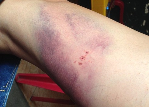 Xử trí vết bầm sau té ngã - ảnh 1